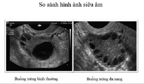 Đa nang buồng trứng có thể gây hậu quả nghiêm trọng nhất là vô sinh.