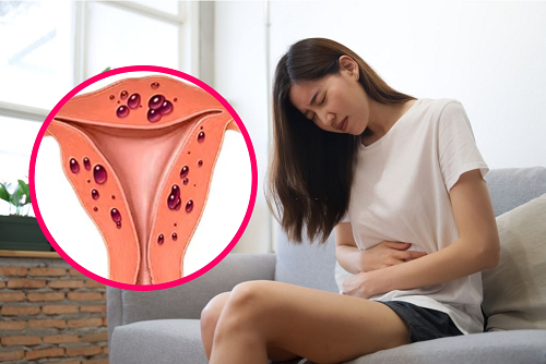Đau bụng trong chu kỳ kinh nguyệt có thể là dấu hiệu của lạc nội mạc tử cung.