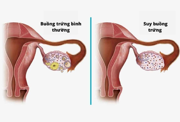 Phụ nữ bị suy buồng trứng, kinh nguyệt không đều và giảm khả năng sinh sản.