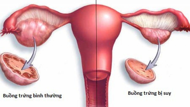 Suy buồng trứng sớm cũng có thể là một trong những nguyên nhân gây vô kinh.
