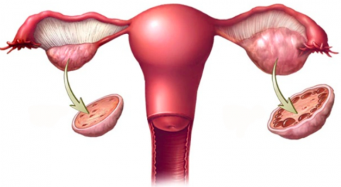 Buồng trứng bình thường (trái) và buồng trứng đa nang (phải). Ảnh: Mayo Clinic