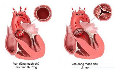 Hẹp van động mạch chủ là bệnh phổ biến nhất về van tim