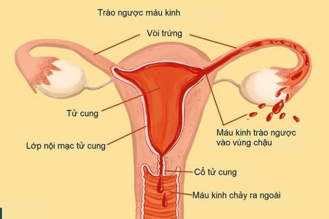 Hình ảnh lạc nội mạc tử cung.