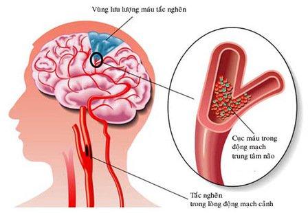 Nguyên nhân gây đột quỵ là do sự bất ổn của tuần hoàn máu não. Ảnh: Vinmec