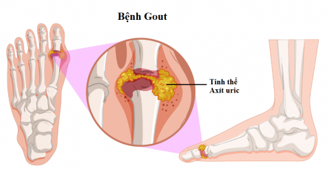benh-gut