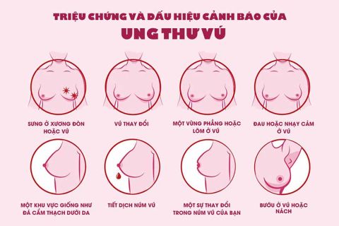 Triệu chứng và dấu hiệu cảnh báo của ung thư vú.