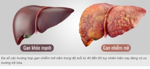 Gan bình thường và gan nhiễm mỡ