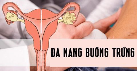 Đa nang buồng trứng là bệnh thường gặp ở phụ nữ.
