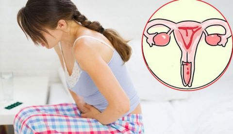 Hội chứng xung huyết vùng chậu là một trong những nguyên nhân phổ biến dẫn đến tình trạng đau vùng chậu mãn tính