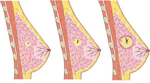 mang-u-vu-breast-lumps