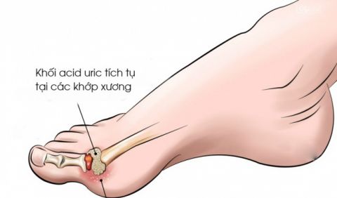 tong-quang-ve-benh-khop-do-tinh-the