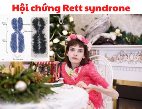 Hội chứng Rett là một hội chứng rối loạn phát triển lan tỏa khá hiếm gặp nhưng vô cùng nguy hiểm