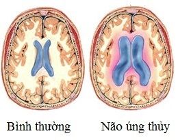 nao-ung-thuy-ap-suat-binh-thuong