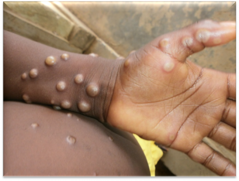 benh-dau-mua-khi-mpox-mpx