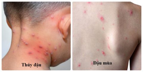 benh-dau-mua-variola