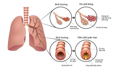 benh-phoi-tac-nghen-man-tinh-copd