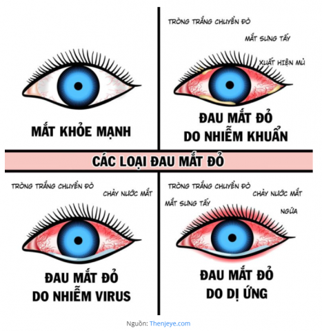 cac-trieu-chung-mat-khac