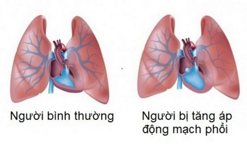 tang-ap-phoi
