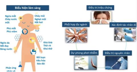 tong-quan-cac-roi-loan-di-ung-va-atopi