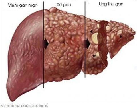 tong-quan-ve-viem-gan-man-tinh