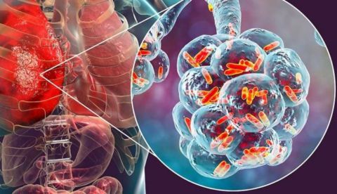 nhiem-trung-legionella