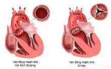 Hẹp van động mạch chủ là bệnh phổ biến nhất về van tim