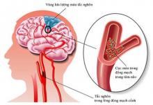 Nguyên nhân gây đột quỵ là do sự bất ổn của tuần hoàn máu não. Ảnh: Vinmec