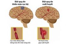 Nguy cơ đột quỵ cao hơn ở những người từng bị thiếu máu não cục bộ thoáng qua.