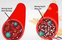 Đường huyết cao là tình trạng lượng glucose trong máu tăng vượt quá mức so với bình thường