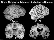 benh-alzheimer