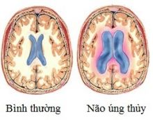 nao-ung-thuy-ap-suat-binh-thuong